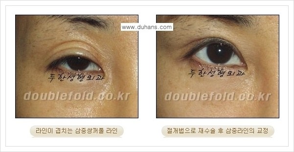[두한성형외과 경쟁력 쌍꺼풀 재수술, 극한 재수술] - [삼중(세겹) 쌍꺼풀 라인의 교정 안내] 관련 이미지 5
