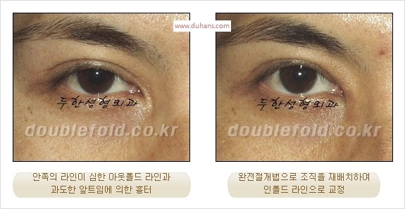 [두한성형외과 경쟁력 눈성형] - [완전절개법(Full incision method)의 재수술 과정] 관련 이미지 10