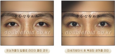 [두한성형외과 쌍커풀수술] - [쌍꺼풀지방이식] 관련 이미지 32