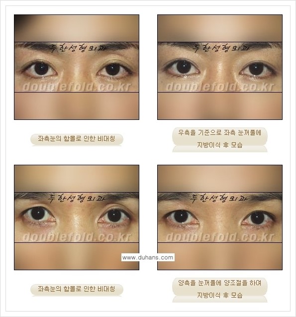 [두한성형외과 경쟁력 쌍꺼풀 재수술] - [짝짝이(비대칭) 쌍꺼풀 라인 교정하는 방법 안내 2.] 관련 이미지 9