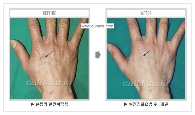 [두한성형외과 정맥류 치료] - [손, 팔 정맥확장증 사진자료 안내 ①] 관련 이미지 9