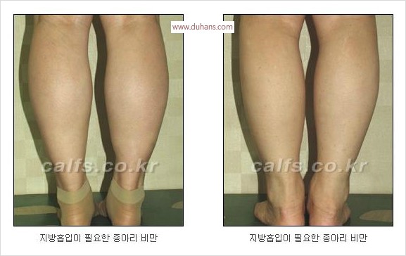 ⁠⁠[두한성형외과 경쟁력 멀티종아리성형] - [지방흡입이 필요한 종아리 비만 안내] 관련 이미지 2