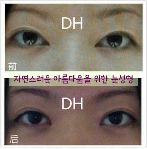 쌍수 두한성형외과 - 몽고주름 제거, 몽고주름 재건 관련 이미지 14