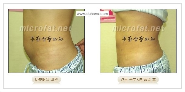 [두한성형외과 경쟁력 바디성형] - [하복부, 팔뚝, 허리선, 허벅지, 엉덩이 간편지방흡입술] 관련 이미지 18