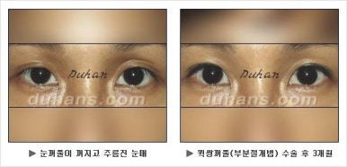 Best Place for Double Eyelid Revision Surgery, Duhan Plastic Surgery - Partial Incision Eye Revision Surgery image 13