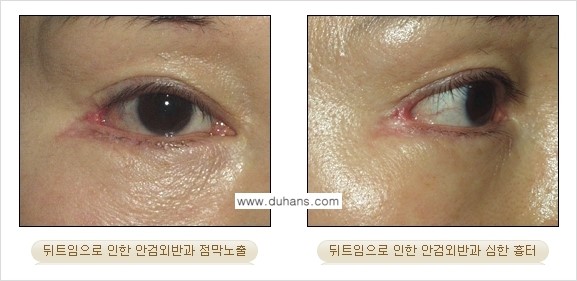[두한성형외과 NO.1 눈성형] - [뒤트임 수술에 대한 정보] 관련 이미지 8