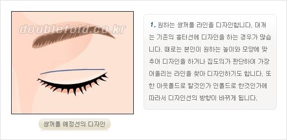 [두한성형외과 경쟁력 쌍꺼풀 재수술, 극한 재수술] - [쌍꺼풀 재수술의 과정 안내 2.] 관련 이미지 4