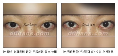 Best Place for Double Eyelid Revision Surgery, Duhan Plastic Surgery - Partial Incision Eye Revision Surgery image 15