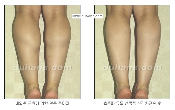 [두한성형외과 경쟁력 멀티종아리성형] - [종아리 퇴축수술 방법들의 문제점] 관련 이미지 16