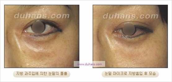 [두한성형외과 경쟁력 지방흡입] - [볼살, 턱선의 간편 지방흡입] 관련 이미지 27