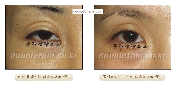 [두한성형외과 경쟁력 쌍꺼풀 재수술] - [삼중(세겹) 쌍꺼풀 라인, 눈꺼풀이 함몰된 삼중(세겹) 쌍꺼풀 라인 교정] 관련 이미지 1