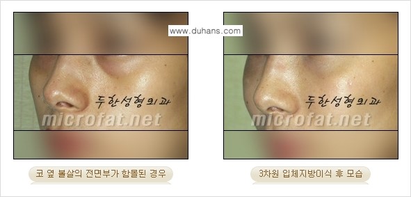 [두한성형외과의 경쟁력 미세지방이식] - [귀족수술과 인디언밴드 미세지방이식 안내 ③] 관련 이미지 5