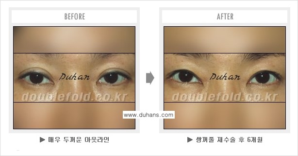 [두한성형외과 쌍꺼풀 재수술] - [쌍꺼풀 재수술에서 잘못된 수술로 인한 넓어진 흉터 처리 문제] 관련 이미지 8