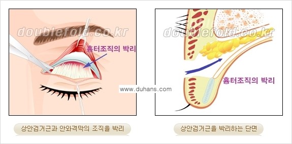 [두한성형외과 NO.1 "극한 눈(쌍꺼풀 재수술)"] - [안검하수(졸린눈매) 재수술 안내 2.] 관련 이미지 5
