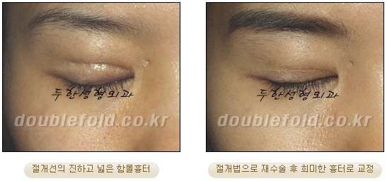 쌍꺼풀수술 두한성형외과 - 쌍커풀재수술의 문제점 관련 이미지 3