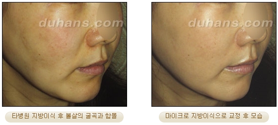 [두한성형외과 얼굴자가지방이식] - [볼살, 이마, 측두부] 관련 이미지 36