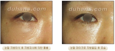 [두한성형외과 안전한 지방흡입] - [얼굴지방흡입] 관련 이미지 31