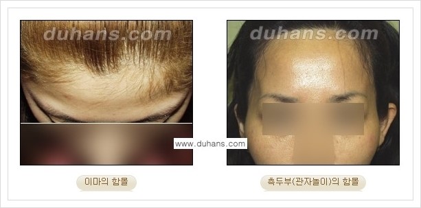 [두한성형외과 경쟁력 얼굴미세지방이식] - [볼살지방이식, 이마지방이식, 측두부지방이식 안내] 관련 이미지 1