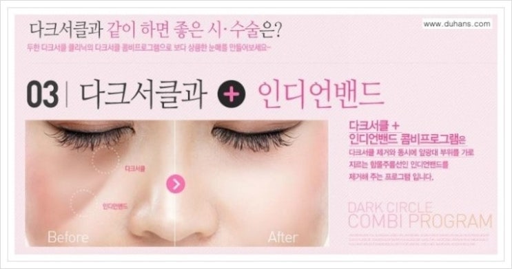[두한성형외과  경쟁력 다크써클 교정] - [다크써클 + 인디언밴드 교정 안내] 관련 이미지 2