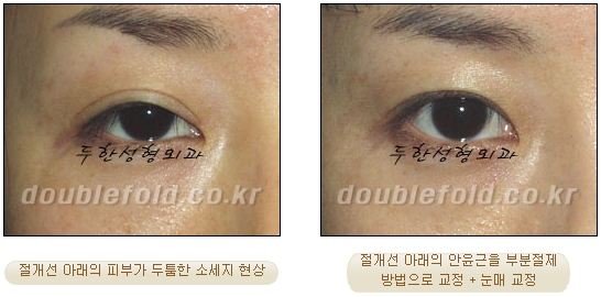 두한성형외과 쌍커풀 재수술 - 눈매교정 재수술 관련 이미지 72