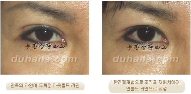 Best Place for Revision Eyelid Surgery, Duhan Plastic Surgery - Lowering Double Eyelid Line image 20