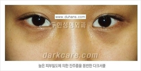 [두한성형외과 경쟁력 눈밑성형] - [눈밑 다크써클 원인과 눈밑 다크써클 치료 방법 안내] 관련 이미지 7