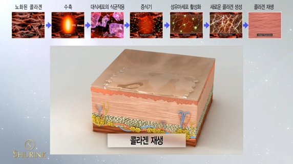두한성형외과 주름개선 - 주름 HIFU 리프팅 관련 이미지 9