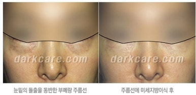 [두한성형외과 다크서클 수술방법] - [NO흉터 눈밑지방제거] 관련 이미지 10
