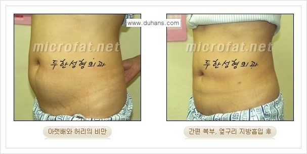[두한성형외과 경쟁력 바디성형] - [하복부, 팔뚝, 허리선, 허벅지, 엉덩이 간편지방흡입술] 관련 이미지 19