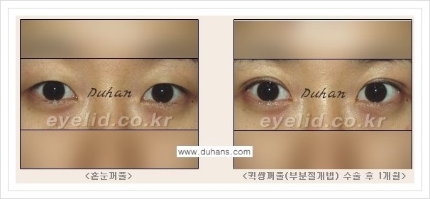 [두한성형외과 경쟁력 쌍꺼풀 재수술, 극한 재수술] - [퀵쌍꺼풀(부분절개법) 안내] 관련 이미지 3