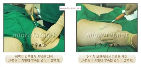 [두한성형외과 경쟁력 귀족성형] - [3차원 입체 미세지방이식 귀족수술 + 인디언밴드 교정] 관련 이미지 29