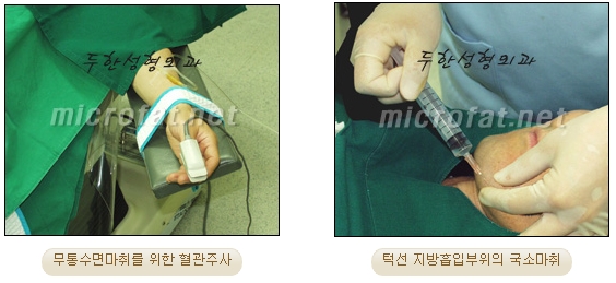 [Duhan Plastic Surgery Liposuction] - [Facial Liposuction] image 3