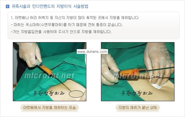 [두한성형외과의 경쟁력 미세지방이식] - [귀족수술과 인디언밴드 미세지방이식 안내 ②] 관련 이미지 7