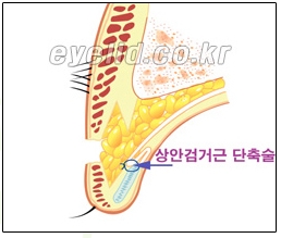 [두한성형외과 쌍꺼풀재수술] - [쌍꺼풀재수술성공요건, 쌍꺼풀재수술과정] 관련 이미지 15