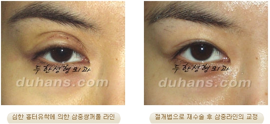 [두한성형외과 쌍커풀재수술] - [재수술방법과 성공요건 안내] 관련 이미지 50