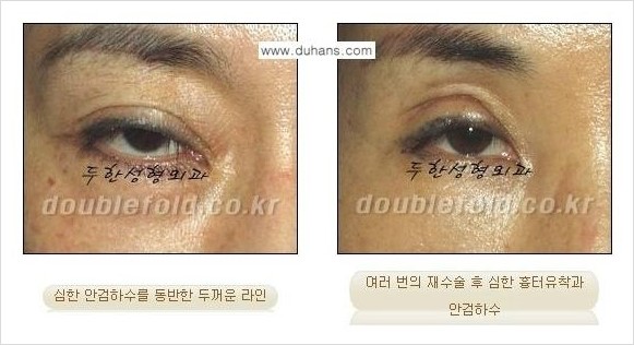 [두한성형외과 경쟁력 눈성형] - [극한의 망가진 쌍꺼풀 복원수술과 일반 쌍꺼풀 재수술과의 차이점 안내] 관련 이미지 2