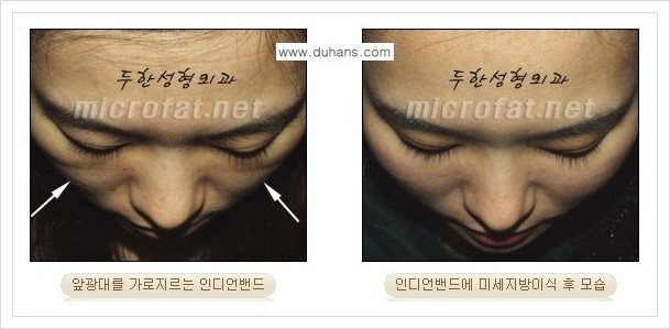⁠⁠[두한성형외과 경쟁력 미세지방이식] - [미세지방이식을 이용한 귀족수술 + 인디언밴드 시술 안내] 관련 이미지 3