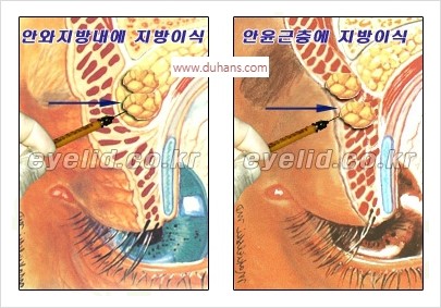 [두한성형외과 경쟁력 안검성형] - [꺼진 눈꺼풀, 눈꺼풀 함몰, 윗눈꺼풀 미세지방이식] 관련 이미지 5