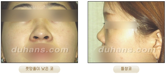 Duhan Plastic Surgery Rhinoplasty - Revision Rhinoplasty Methods image 2