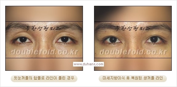 [두한성형외과 경쟁력 쌍꺼풀 재수술, 극한 눈재수술] - [미세지방이식으로 쌍꺼풀 라인의 복원에 관한 질문과 답변] 관련 이미지 7