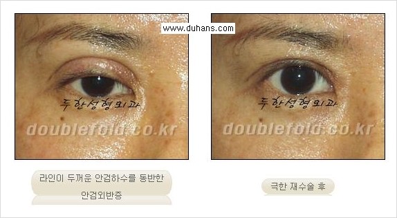 [두한성형외과 경쟁력 쌍꺼풀 재수술, 극한 재수술] - [재수술에서 극복해야 할 극한의 상황과 문제들 안내] 관련 이미지 14