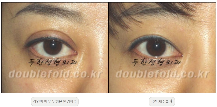 [Duhan Plastic Surgery Double Eyelid Revision] - [Thick Double Eyelid Line] image 45
