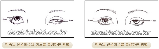 과교정 눈매 (소세지 쌍커풀 재수술, 눈매교정 재수술) 관련 이미지 12