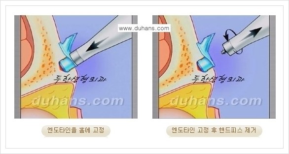 [두한성형외과 경쟁력 주름교정술] - [엔도타인 리프팅 안내 ③] 관련 이미지 5