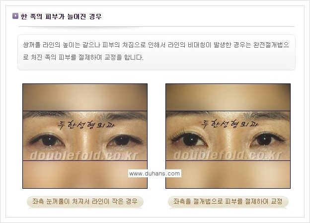 [두한성형외과 경쟁력 쌍꺼풀 재수술] - [짝짝이(비대칭) 쌍꺼풀 라인 교정하는 방법 안내 2.] 관련 이미지 2