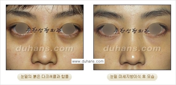 [두한성형외과 경쟁력 미세지방이식] - [다크써클 & 눈밑주름 미세지방이식 3.] 관련 이미지 15