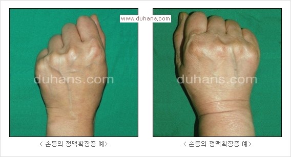 [두한성형외과 경쟁력 정맥류 치료] - [정맥류 치료의 모든 것] 관련 이미지 27