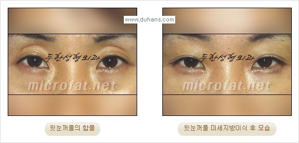 [두한성형외과 경쟁력 안검성형] - [꺼진 눈꺼풀, 눈꺼풀 함몰, 윗눈꺼풀 미세지방이식] 관련 이미지 28