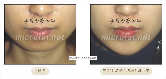 [두한성형외과 경쟁력 미세지방이식] - [부드럽고 아름다운 얼굴윤곽선 턱(하악부) 미세지방이식 안내] 관련 이미지 22