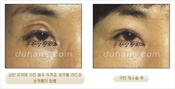 [두한성형외과 경쟁력 쌍꺼풀 재수술 리더 ] - [쌍꺼풀 재수술 과정, 쌍꺼풀 재수술 실패의 원인, 극한 재수술] 관련 이미지 3